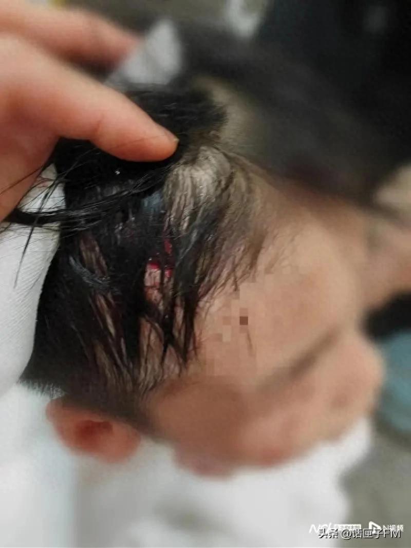 The bathroom glass door of a five-star hotel suddenly burst, injuring two boys and possibly leaving sequelae!